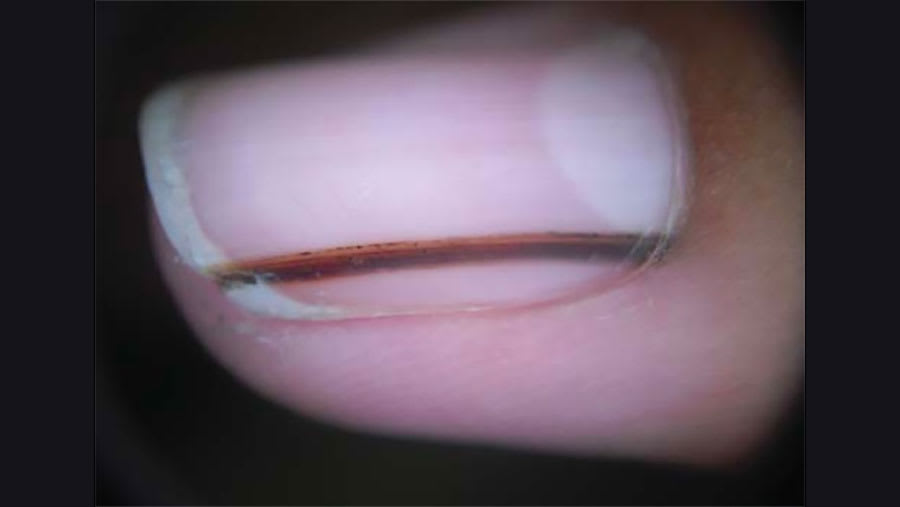 Longutidinal melanonychia on the thumb