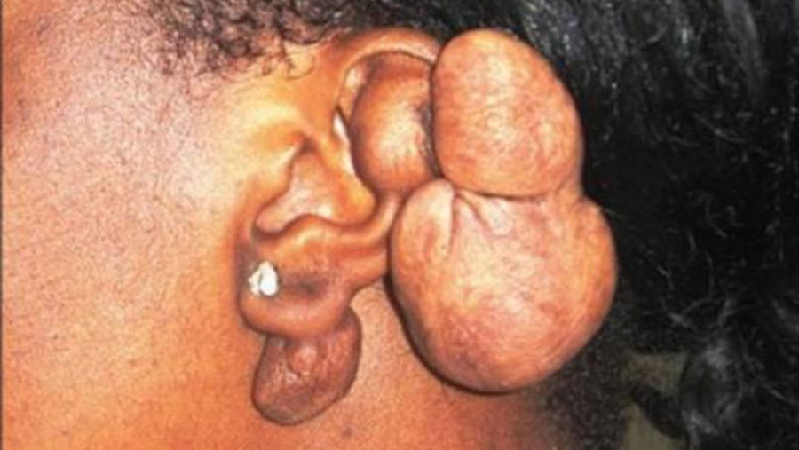 Keloid scar on the left ear