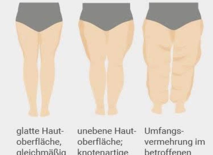 stützstrümpfe bei lipödem