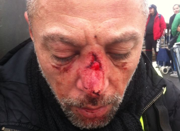 Cagnotte de Solidarité en faveur de Franck gilet jaune touché au visage par un tire de LBD 40