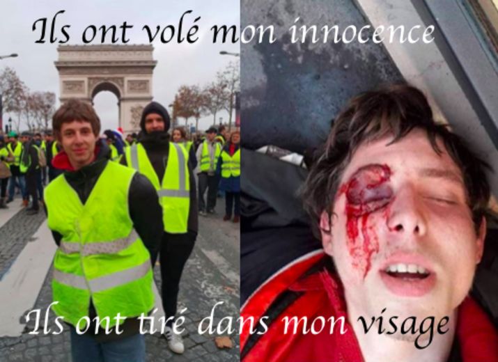 Je m'appel Franck, j'ai 20 et j'ai été défiguré par les forces de l'ordre