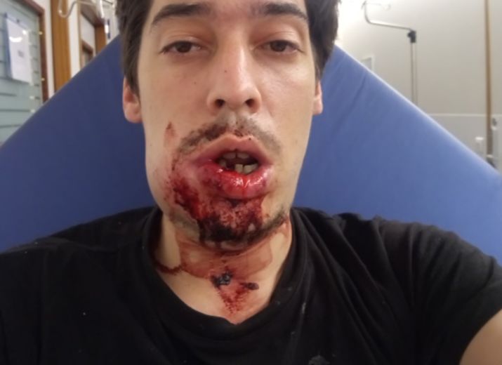 Je m'appelle Élie et j'ai était victime d'un tir de flash Ball en pleine tête