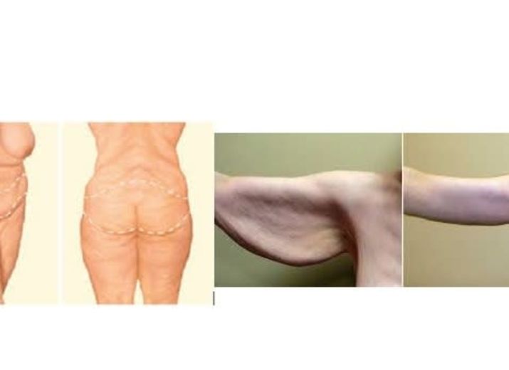 chirurgie apres perte de poids