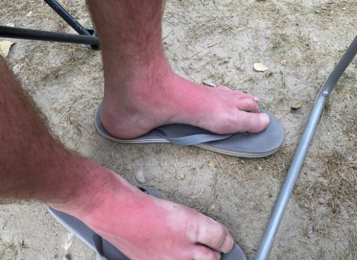 Coup De Soleil Jambes Impossible De Marcher