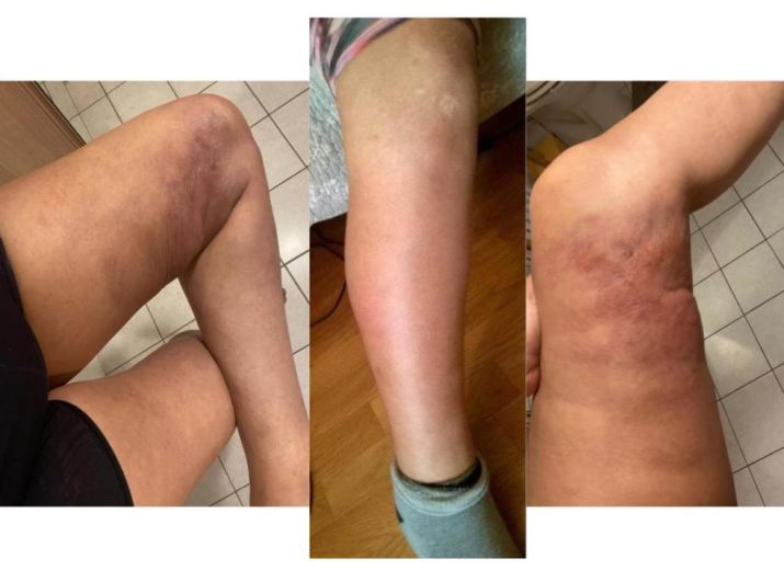 Aider Alondra à soigner les conséquences du silicone