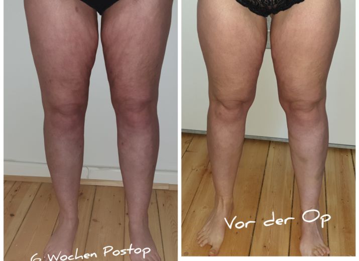Money Pot 2 Lipodem Operation Leetchi Com
