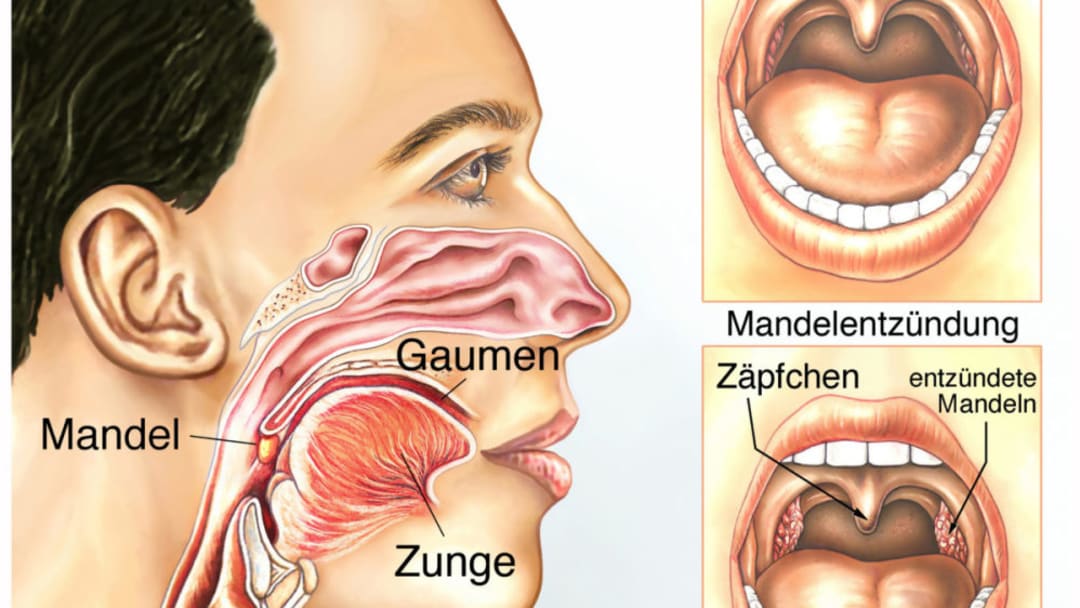 Operate now: Tonsil Surgery 