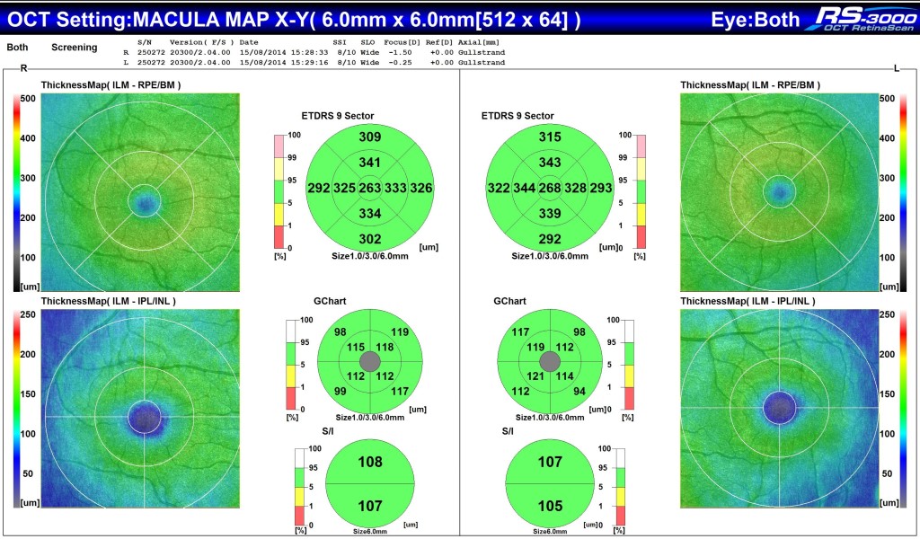 OCT scan results.