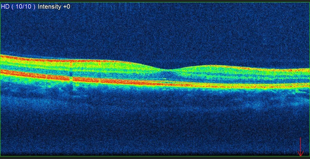 oct scan