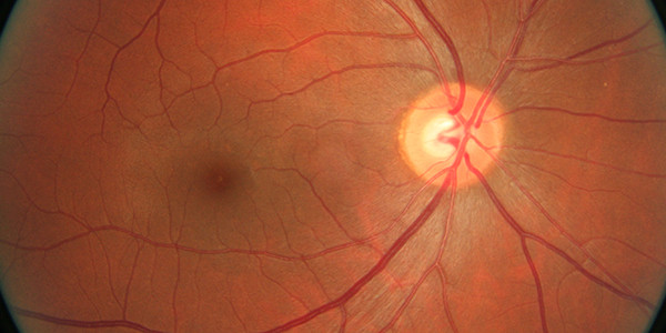 A close-up of retinal photography.