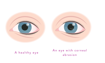 Corneal Abrasion