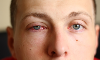 Conjunctivitis