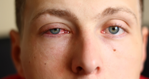 Conjunctivitis