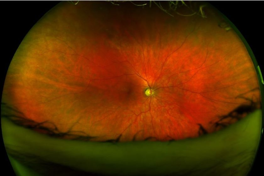 Optomap Eye Examination | Leightons