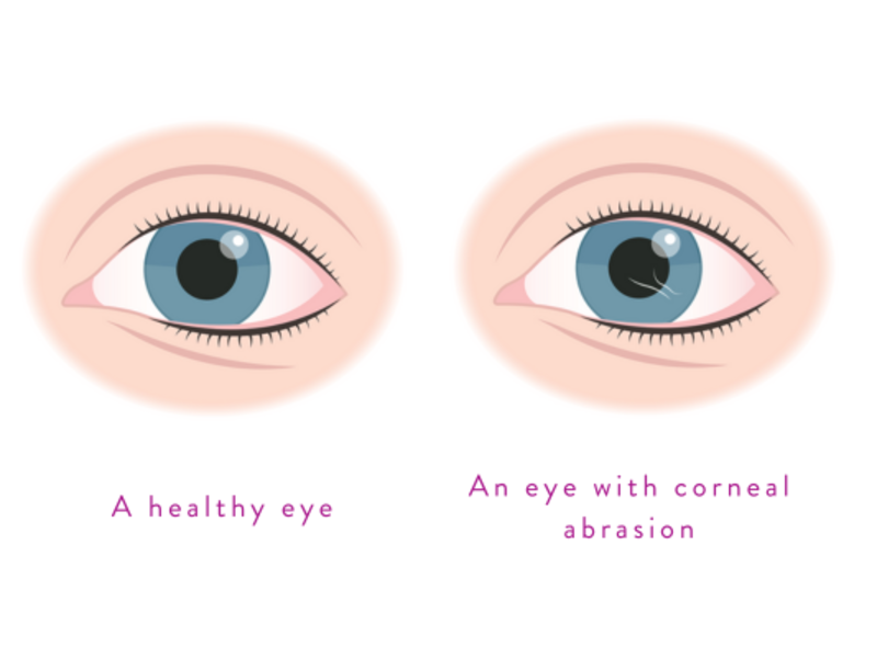 A graphic showing the difference between a healthy eye and an eye with corneal abrasion.