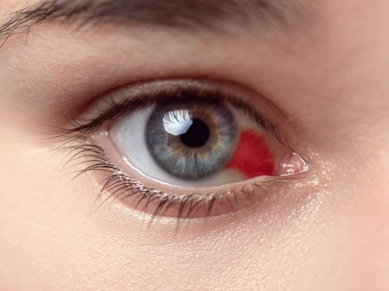 Woman with burst blood vessel in eye.