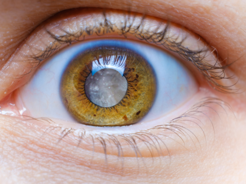 Closeup view of woman eye with cataract.
