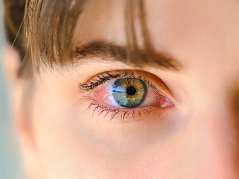 A close-up view of a green eye showing inflammation and prominent red blood vessels.