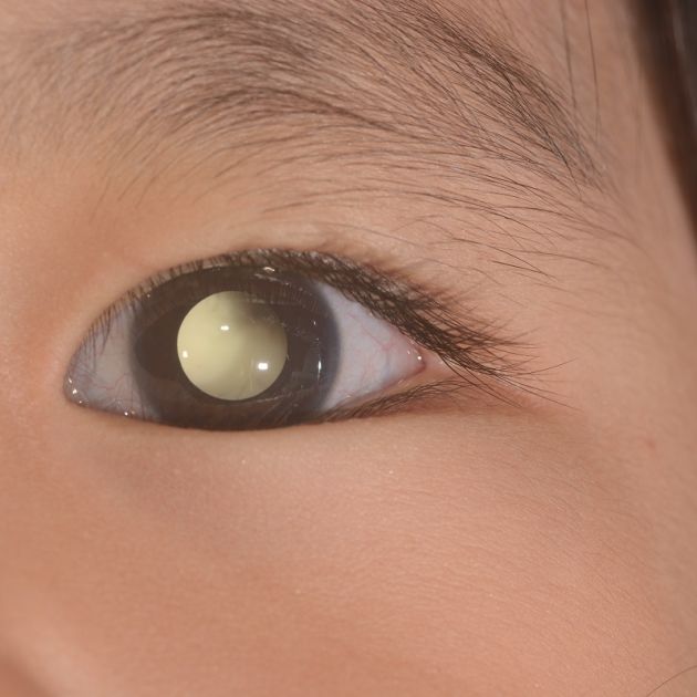 A child's eye with retinoblastoma.