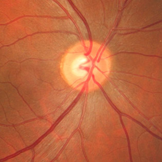 Retinal photography of an human eye.