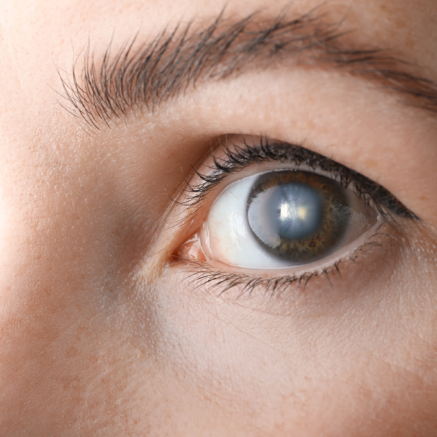 Close-up of an woman eye suffering from cataract.