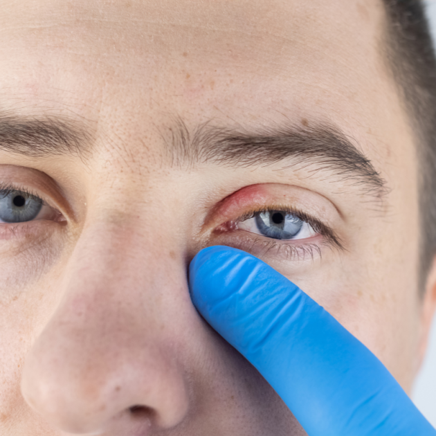 Man with blepharitis on upper eye.