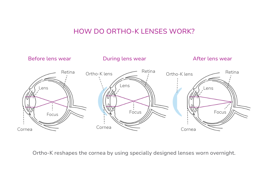 A diagram illustrating the process of orthokeratology (ortho-k), showing an eye before, during, and after wearing ortho-k contact lenses, demonstrating how the cornea is reshaped.