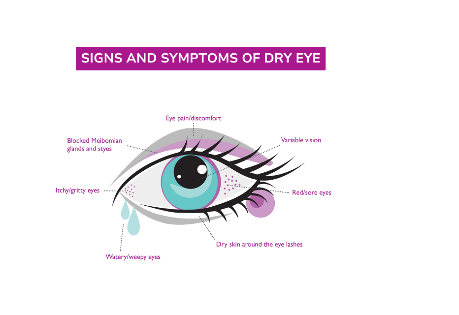 Infographic illustrating the signs and symptoms of dry eye, featuring visual representations and informative text.