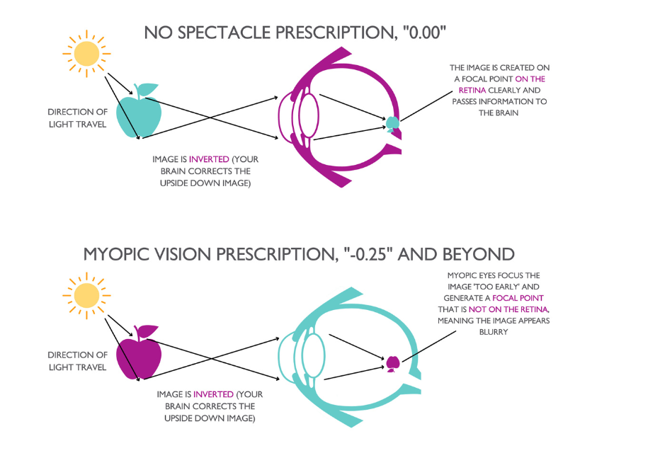 Diagram illustrating how myopia affects vision, showing the differences in light focus and resulting visual clarity.