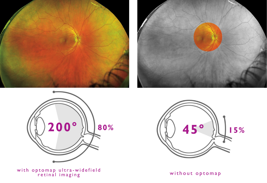 optomap with ultra-wide retinal imaging diagram