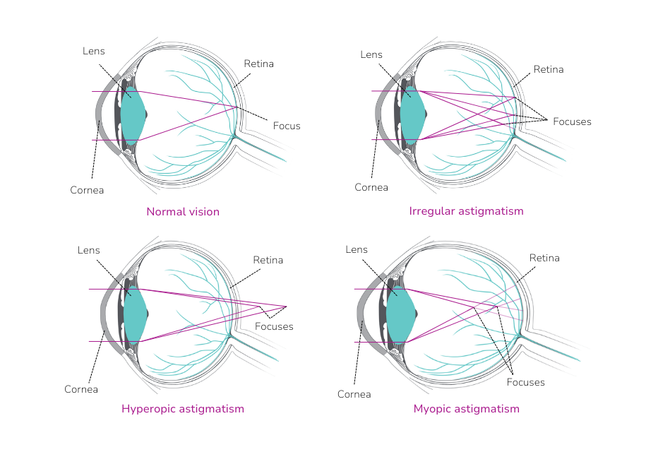 A diagram illustrating different types of astigmatism, showing how light focuses incorrectly on the retina for each type, compared to normal vision.