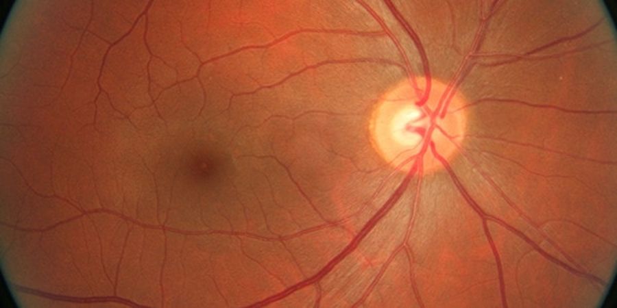 Retinal Image