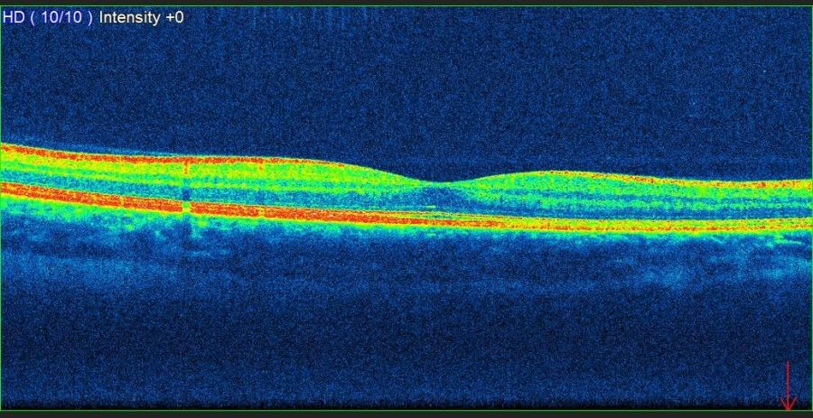oct scan