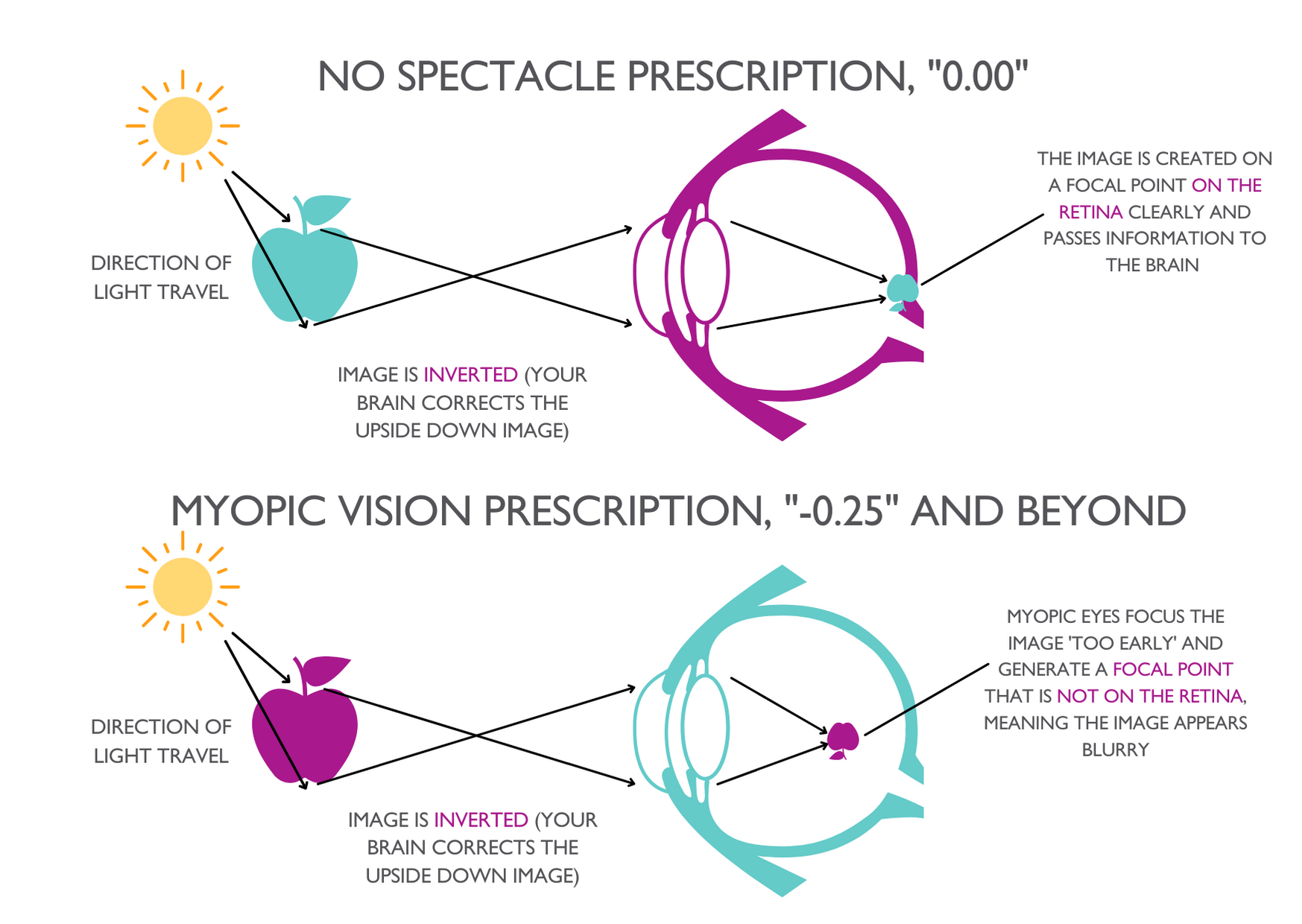 Clinical Myopia Diagram