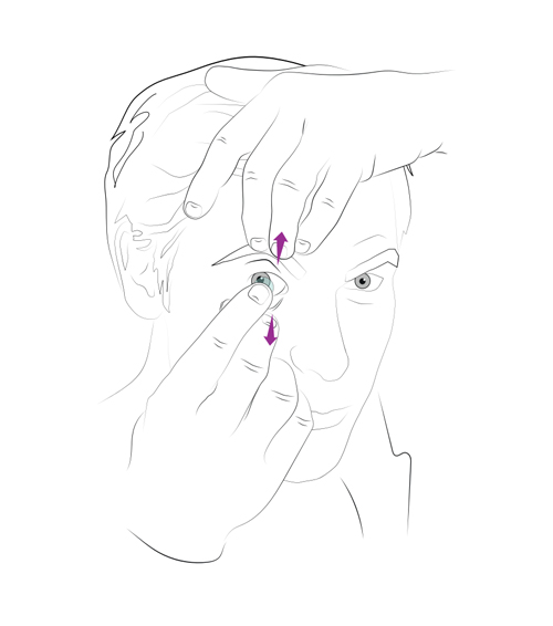 A diagram illustrating the side method of inserting a contact lens