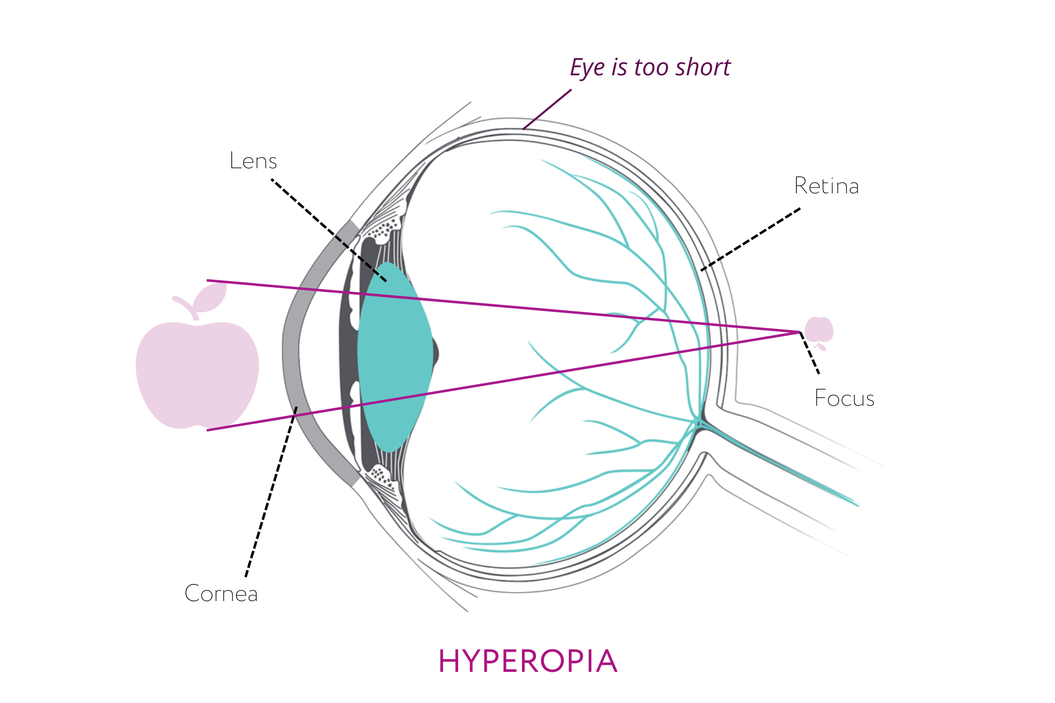 hyperopia causes infographic of eye