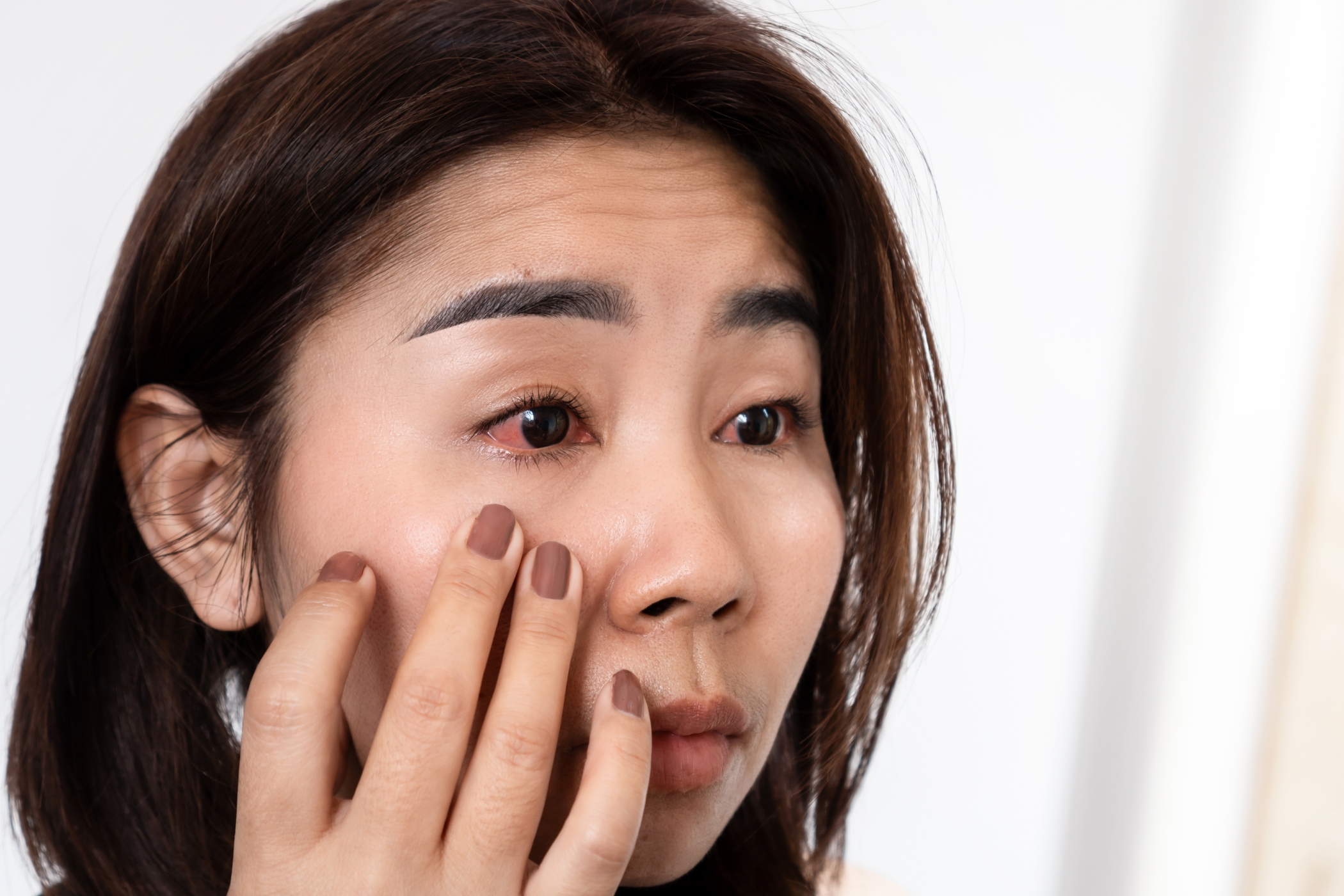 Woman suffering from eye inflammation, with red eyes and visible discomfort.