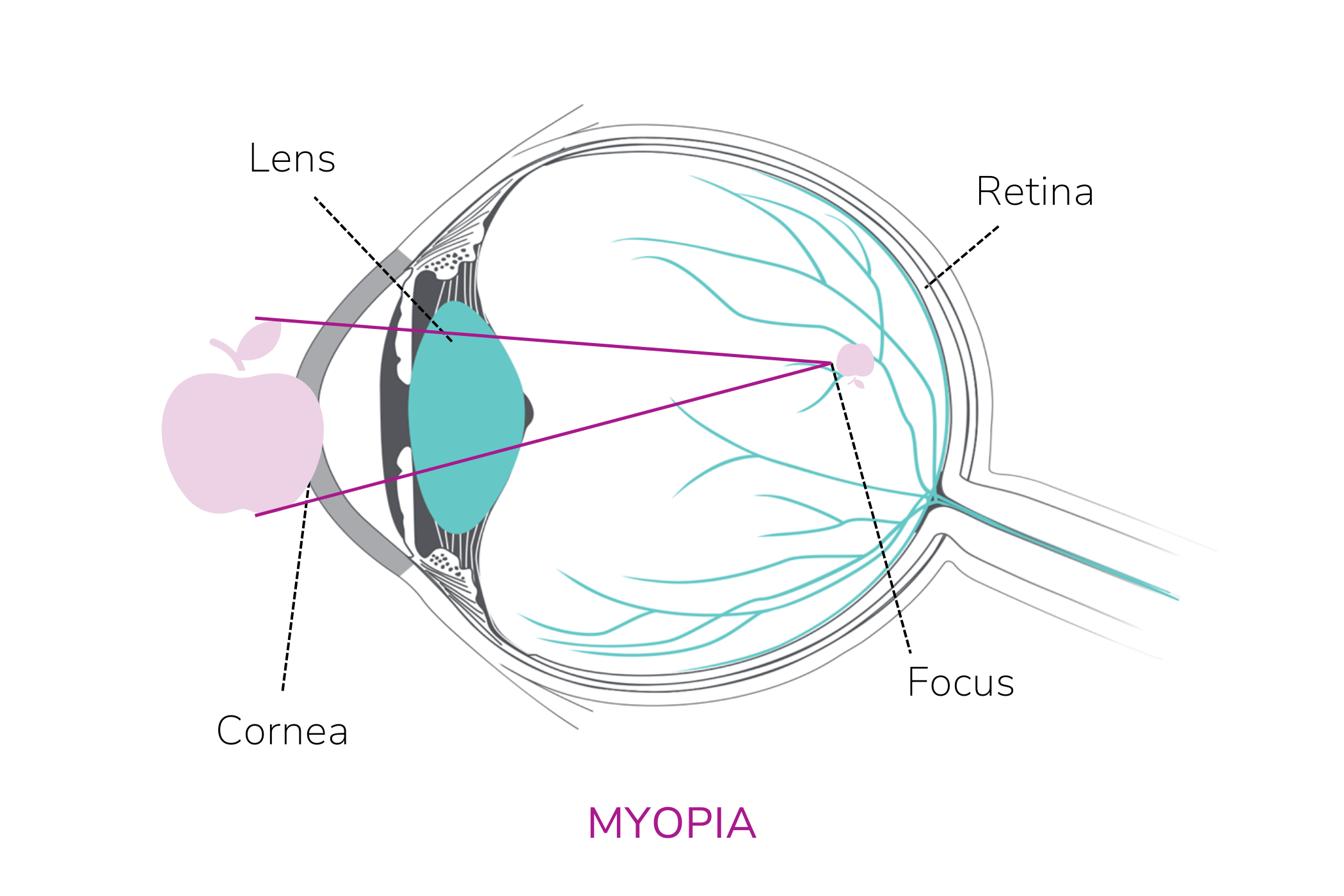 Infographic showing what myopia is, with a diagram of the eye.
