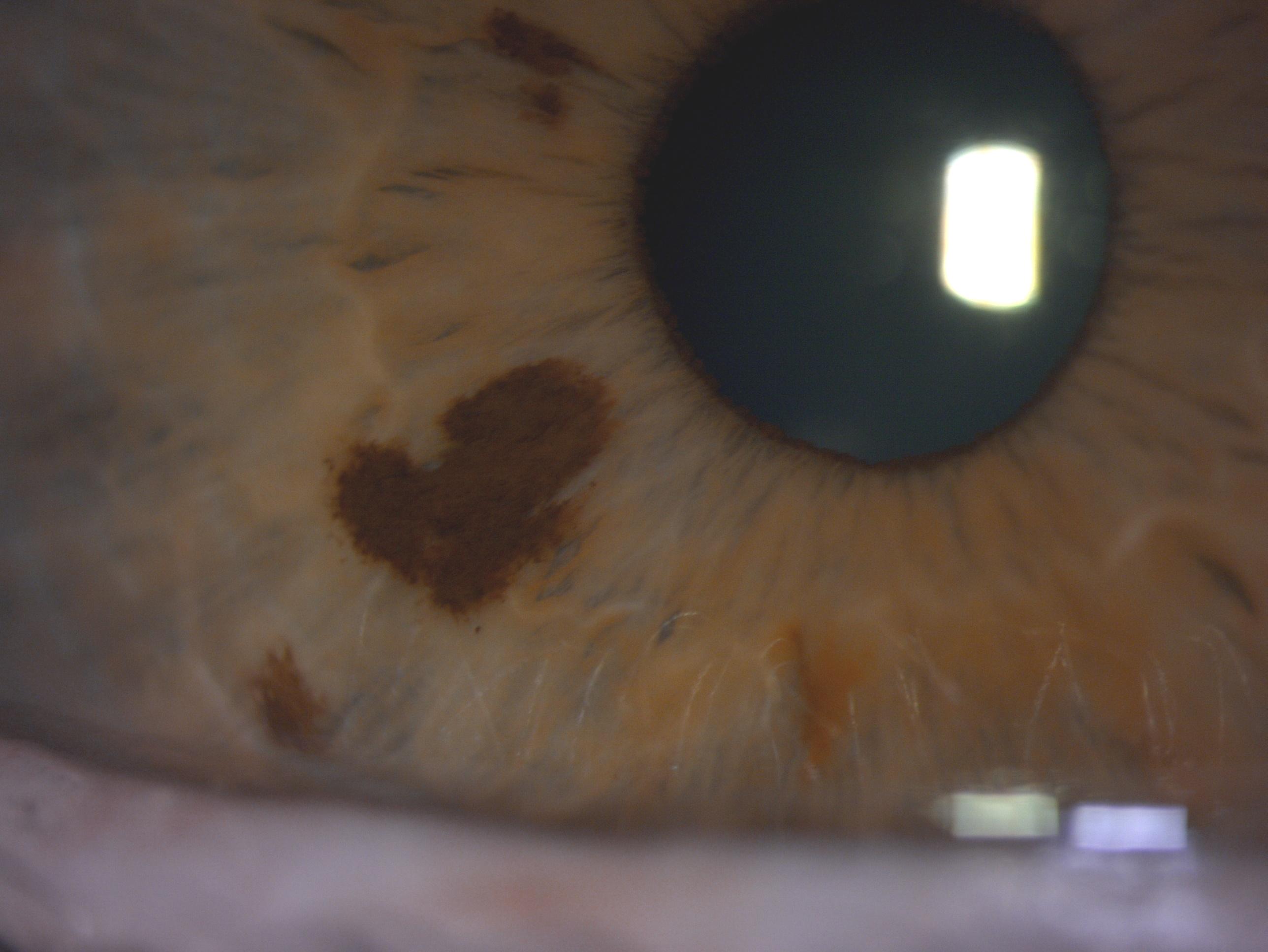 iris freckle