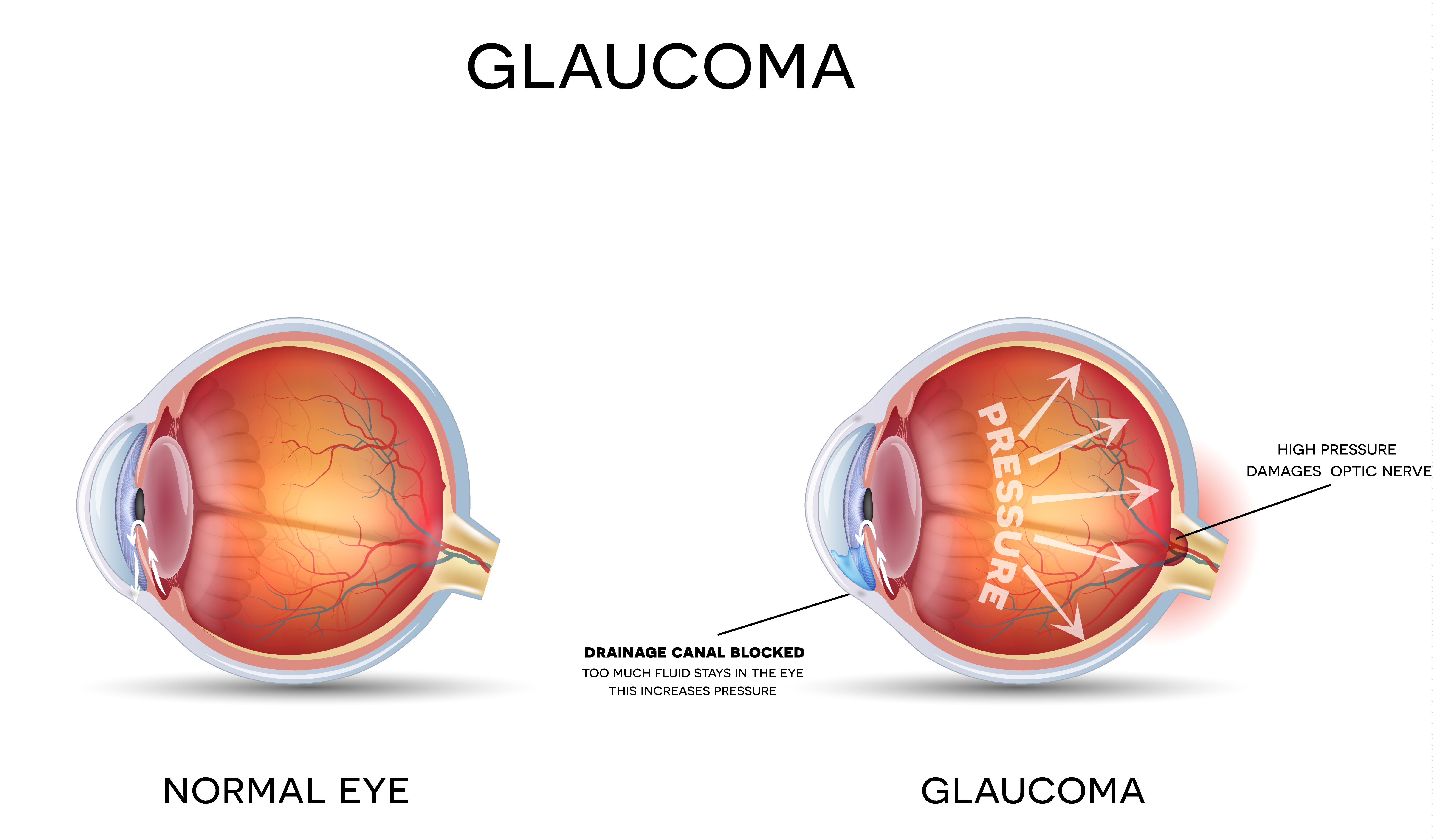 glaucoma-example