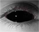Black Sclera