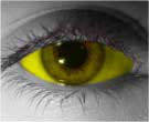 Yellow Sclera