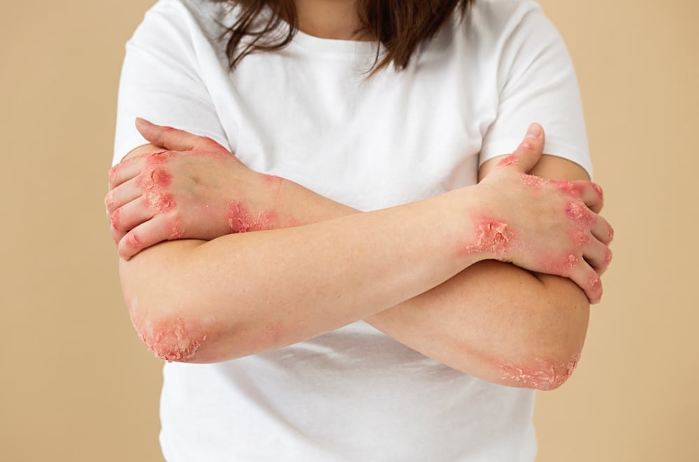 Cure thermale et psoriasis, une approche à prendre en considération