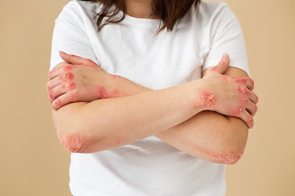 Cure thermale et psoriasis, une approche à prendre en considération