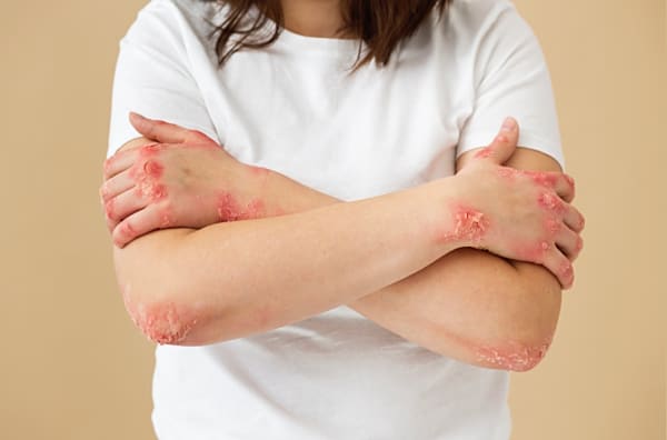 Cure thermale et psoriasis, une approche à prendre en considération