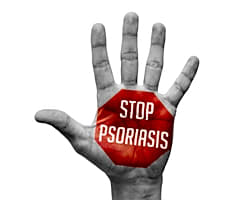 Illustration pour PSOTHERMES : Une étude pour évaluer l’efficacité des cures thermales dans la prise en charge du psoriasis en plaque