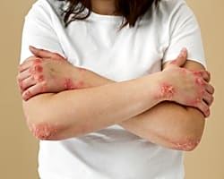 Illustration pour Cure thermale et psoriasis, une approche à prendre en considération