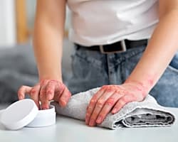 Illustration pour Cure thermale et psoriasis, une alternative à prendre en considération
