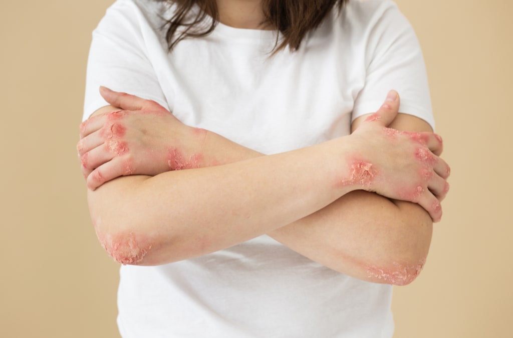 Mains atteintes de psoriasis avec plaques rouges et squames sur la peau