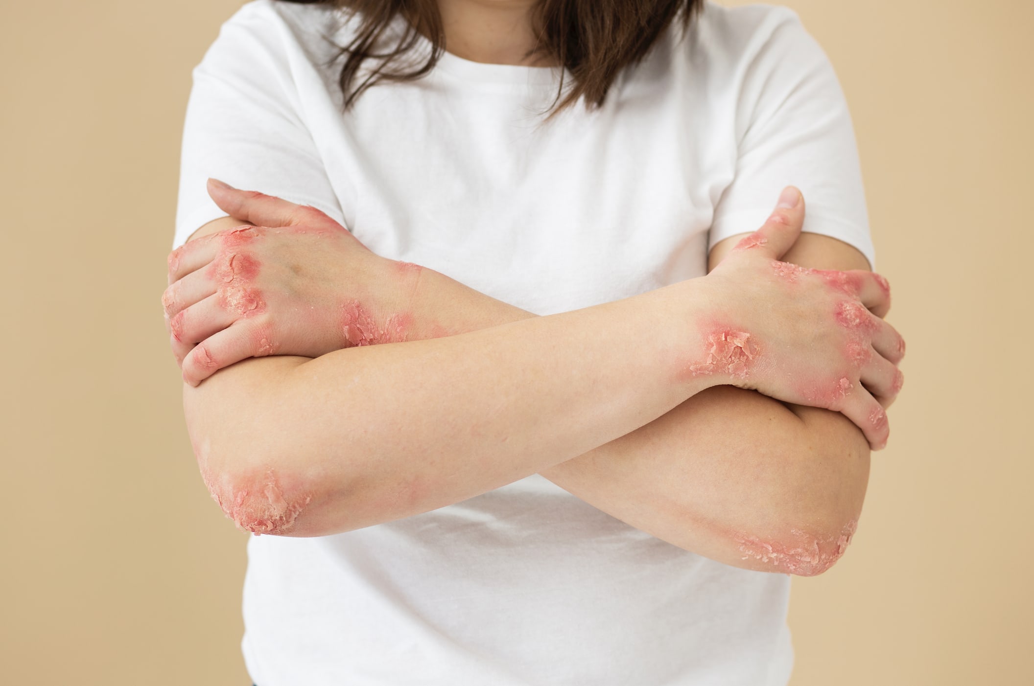 Mains atteintes de psoriasis avec plaques rouges et squames sur la peau